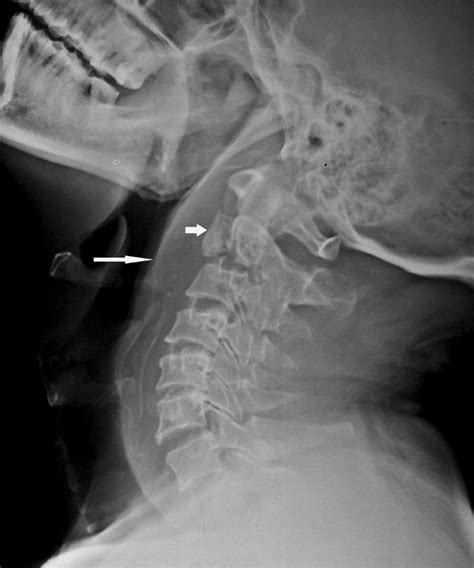 Spontaneous Atraumatic Fracture Of A Cervical Vertebra In Tuberculosis