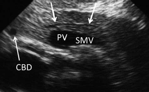 Intraoperative and Laparoscopic Ultrasound During Pancreatic Surgery