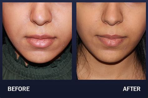 Buccal Fat Removal Before And After Pictures Madnani Facial Plastic Surgery