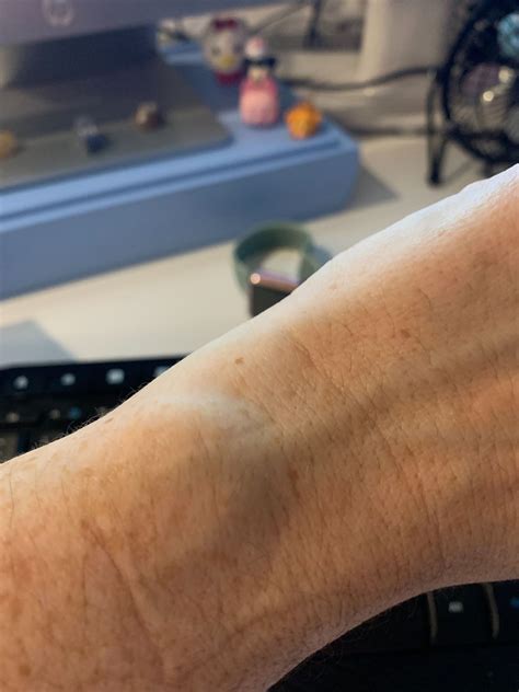 Viral ‘freckle On Wrist Challengel Do You Have One