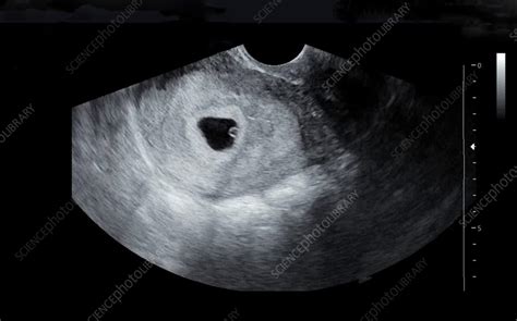 Embryo At Five Weeks Ultrasound Scan Stock Image C0570351