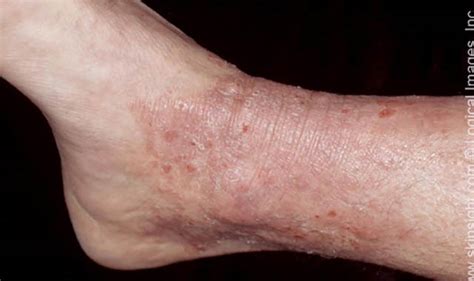 Neurodermatitis Symptoms And Causes National Eczema Association