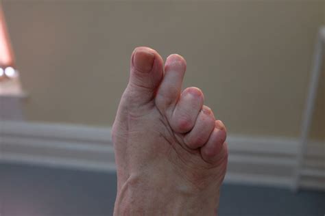 The Pain Of Bent And Twisted Toes Feel Your Feet Community