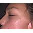 Small Light Textured Bumps Help  Other Acne Treatments Acneorg