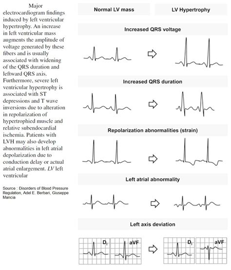 Major Electrocardiogram Findings Induced By Left Ventricular Grepmed