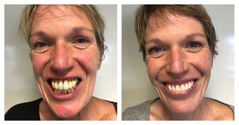 Dental Implant Before And Afters Archives Ace Dental Kentish Town Camden Nw5