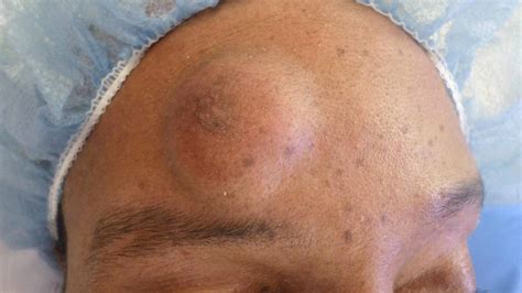 Cureus A Rare Forehead Mass The Chondroid Syringoma