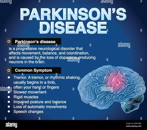 Informative Poster Of Parkinson Disease Illustration Stock Vector Image
