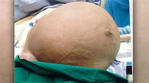 Doctors Remove Massive 28kg Tumour From Womans Uterus