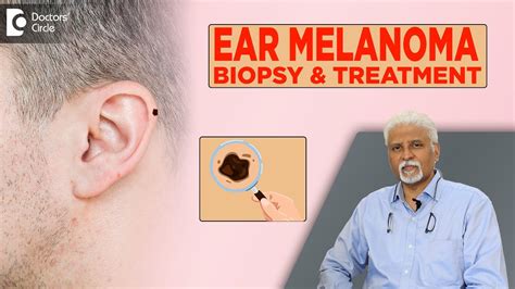 Skin Cancer In Ear Melanoma Inside Ear Diagnosis And Treatment Dr