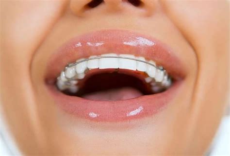 Shifted Teeth After Braces Holdenwashington