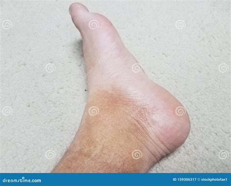Discolored Red Skin On Foot And White Carpet Stock Image Image Of