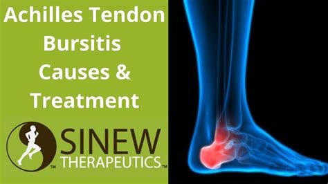 Achilles Tendon Bursitis Causes And Treatment Youtube