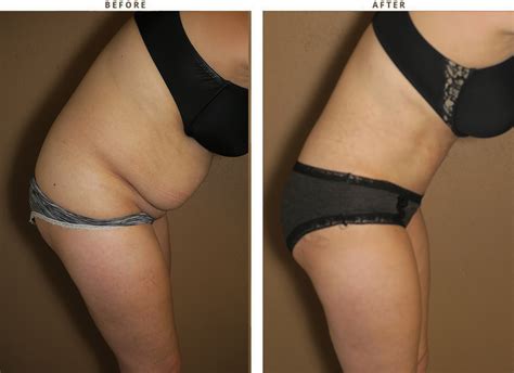 Tummy Tuck Abdominoplasty Before After Pictures Dr Turowski Plastic Surgery Chicago