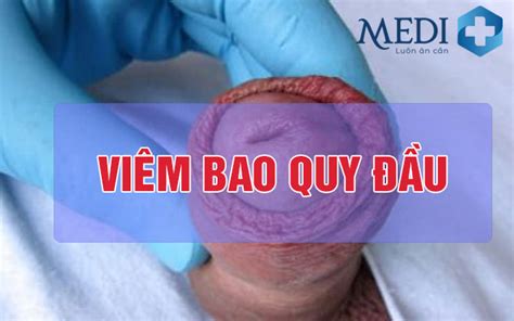 Nguyên Nhân Và Cách điều Trị Viêm Bao Quy đầu Balanitis