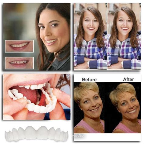 The Original Clip On Smile Instant Smile Veneer Outletizer Picture