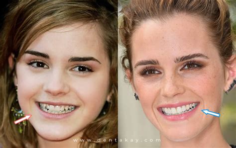 6 Shocking Celebrity Veneers With Before And After Pictures