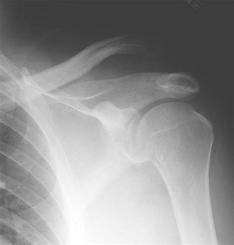 Shoulder and Elbow Surgery: Chronic AC joint separation ...
