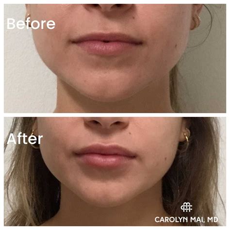 The Best Treatments For Lip Lines Botox Vs Fillers Dr Carolyn Mai