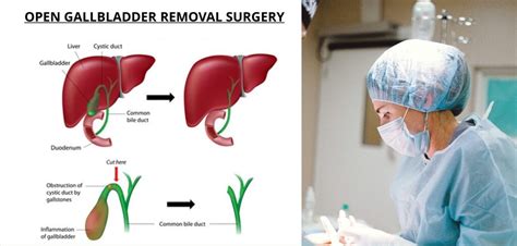 Open Cholecystectomy Procedure Purpose Side Effects