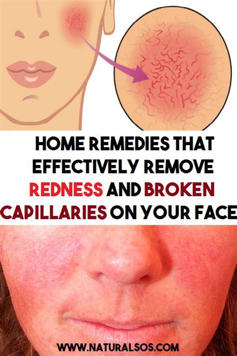 Famous How To Reduce Redness In My Face 2022