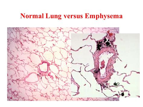 Solved Emphysema Is A Chronic Obstructive Airway Disease Linked To