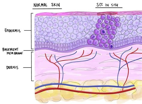 Squamous Carcinoma In Situ Of The Skin Mypathologyreportca