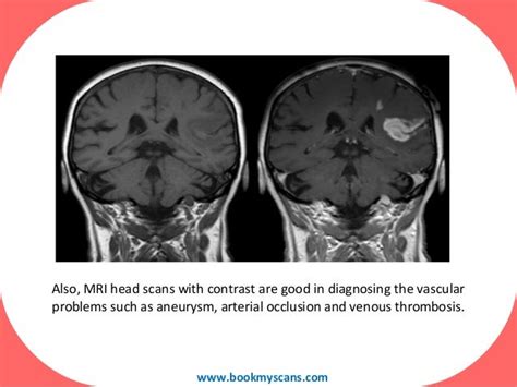 9 Things You Should Know Contrast Scans Mri Or Ct