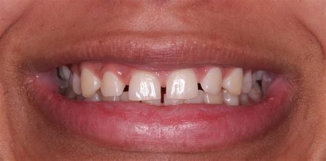 Gappy Smiles Close Gaps In Between Teeth Bespoke Smile