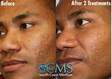 Photos of Best Acne Scar Treatment For Black Skin