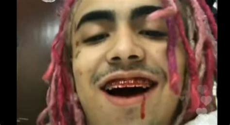 Lil Pump Trips Out After Getting Wisdom Teeth Removed Video New Hit