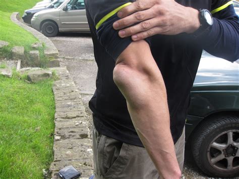 Summary location proximal end of the ulna articulates with the olecranon fossa of the humerus blood supply deep. Olecranon Bursitis
