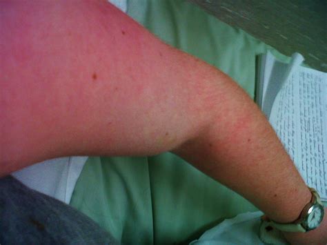 Bright Red Rash On Legs Pictures Photos