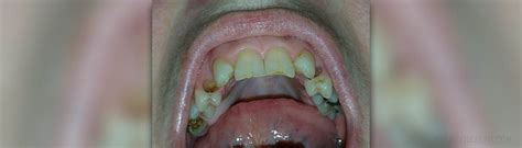 Abscessed Tooth Symptoms Ear Nose Throat And Dental Problems