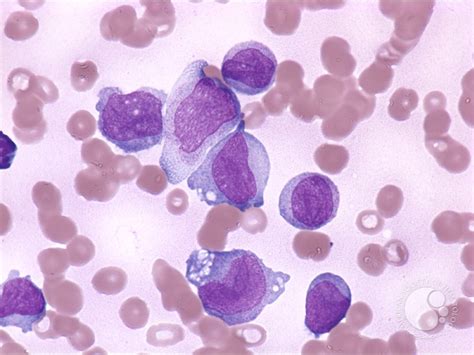 Dysplastic Monocytes 2