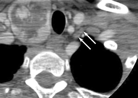 Normal Ct Appearance Of The Distal Thoracic Duct Ajr