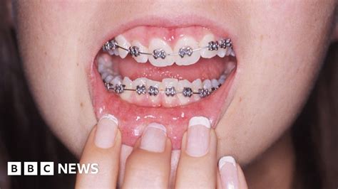 Adult Braces Why Are More Grown Ups Getting Their Teeth Straightened Bbc News