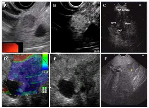 Endoscopic Ultrasound In The Diagnosis And Management Of Carcinoma Pancreas