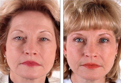 Discover How To Decelerate Furrows And Wilting Tissue With Facial