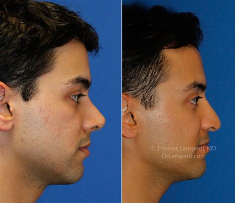 PHOTOS Upturned And Pinched Tip Revision Rhinoplasty Rhinoplasty In Seattle Rhinoplasty Surgeon