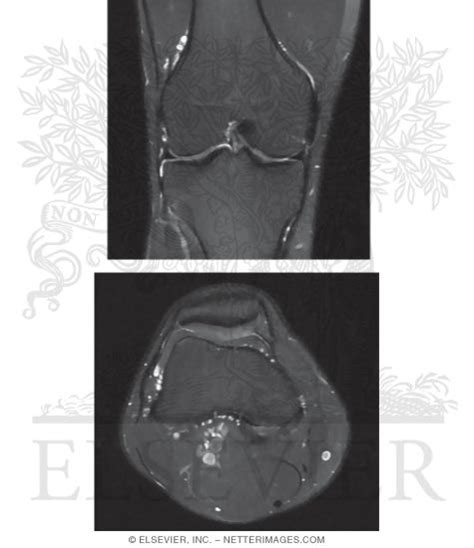 Coronal And Axial T2 Mri Studies Of The Knee