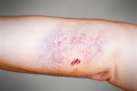 Tiny Red Blood Spots On Skin Austra Health