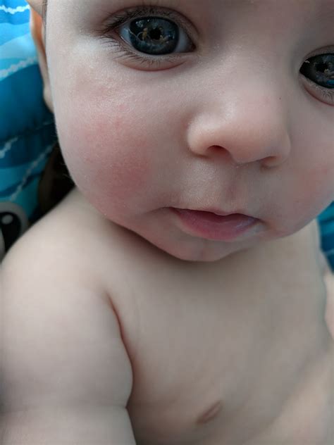 Drool Rash Pic October 2017 Babies Forums What To Expect