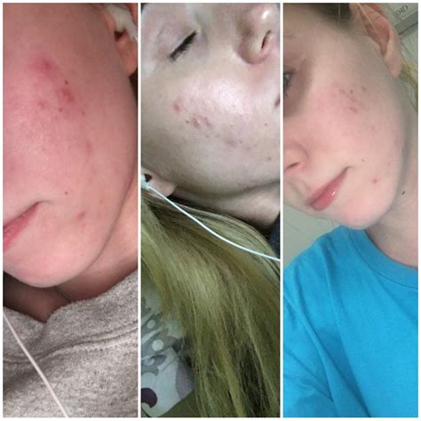 Finally Seeing Results 100 Mg Minocycline Daily Since December Acne