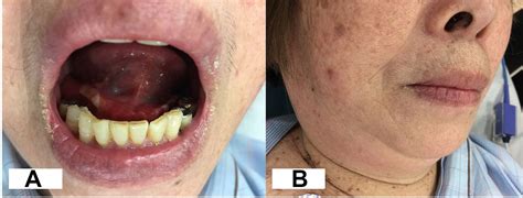 Double Tongue Signs In A Case Of Submandibular Space Infection Bmj