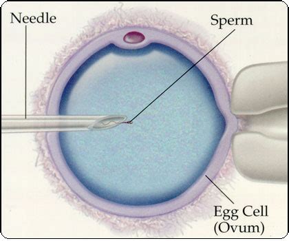 Intracytoplasmic Sperm Injection Red Rock Fertility