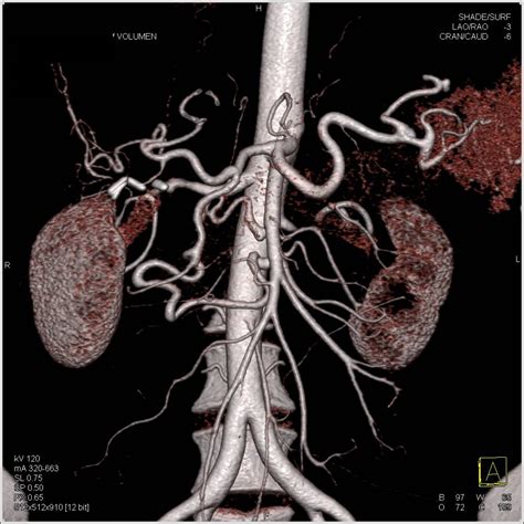 Stenosis Celiac Artery Origin With Flow Through Gastroduodenal Artery Gda And Into Sma