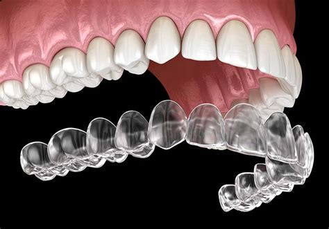 How should you keep your invisalign retainers and other clear teeth aligners clean? Invisalign vs Braces: What Is Best For You? - Dental Haus