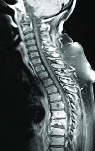 C Spine Mri Showing T8 Fracture And The Begining Of Discitis Download