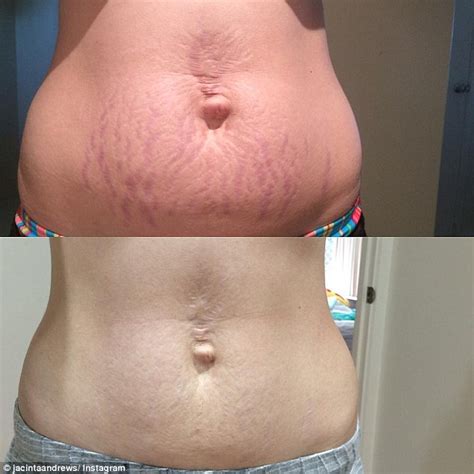 The Miracle 1695 Product That Banishes Stretch Marks Cellulite And